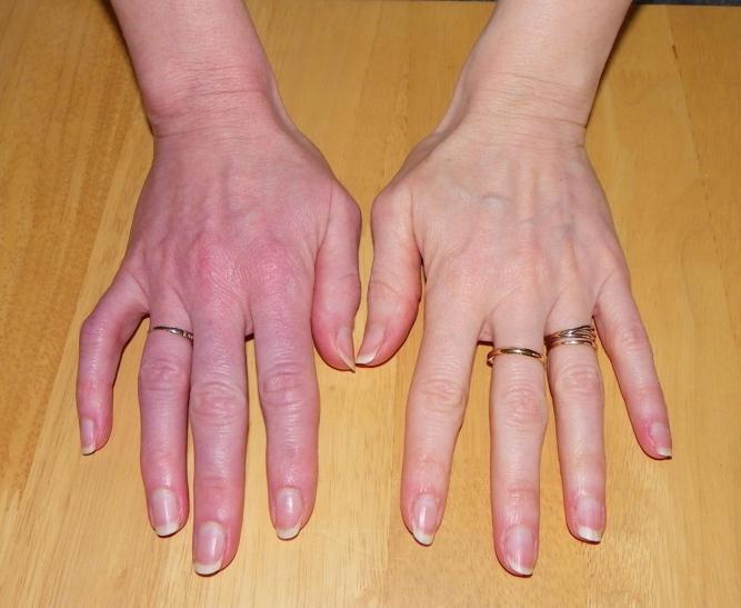 main droite atteinte d'algo (syndrome épaule – main)